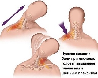 Симптом плечевого неврита
