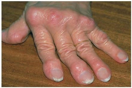Деформация суставов пальцев рук