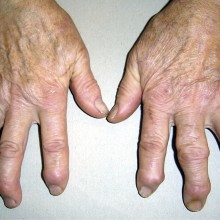 Шишка на пальце руки - симптомы, лечение