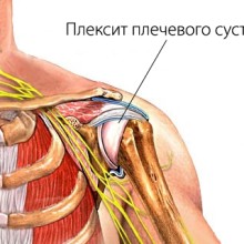 Неврит - это защемление плечевого нерва