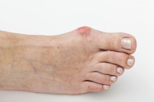 Артрит пальцев на ногах