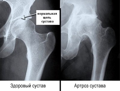 Артроз тазобедренного сустава - рентген