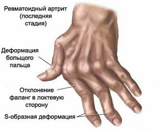 Последняя стадия артрита пальцев рук