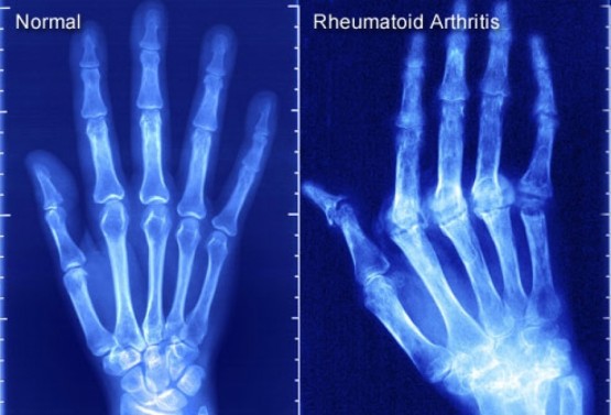 Рентген артрита пальцев рук