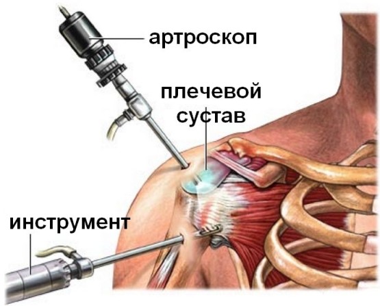 Артроскопия сустава