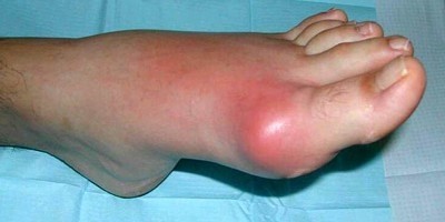 Воспаление сустава пальца ноги