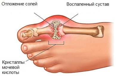 Подагра чаще развивается на ногах, но поражает и руки