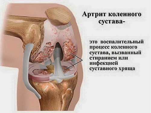 Пример артроза коленного сустава