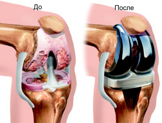 Хирургическое протезирование коленного сустава