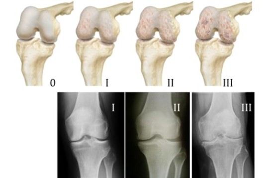 Стадии развития артроза коленного сустава