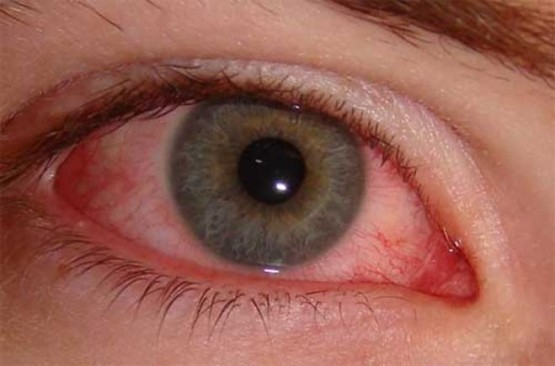 Воспаление глаз - один из симптомов реактивоного артрита