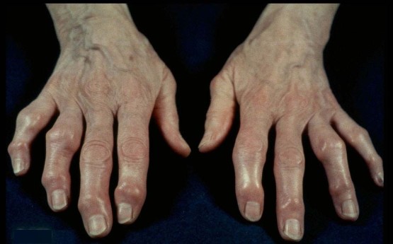 Симптомы остеоартроза пальцев рук
