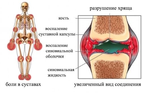 Полиартроз обычно развивается на симметричных суставах