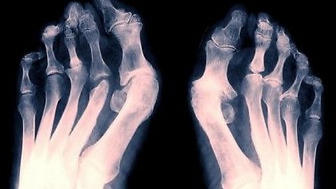 Рентген поврежденного сустава ноги