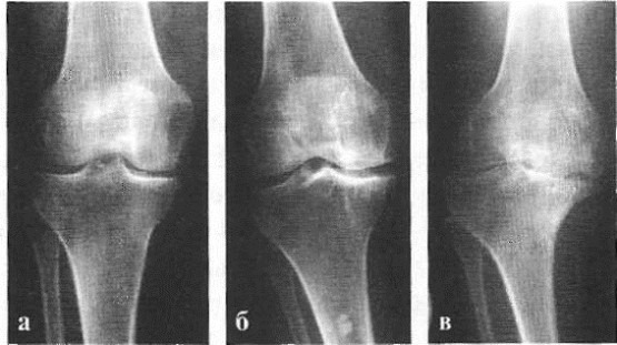 Артрит коленного сустава рентген