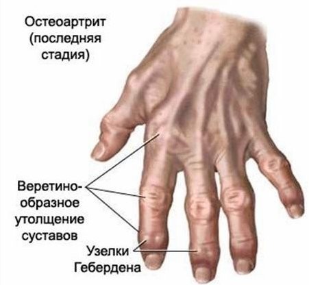 Искривление пальцев рук причины